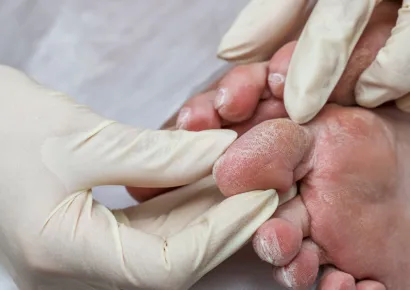 Certificate in Diabetic Foot Care - Endocrinology Course